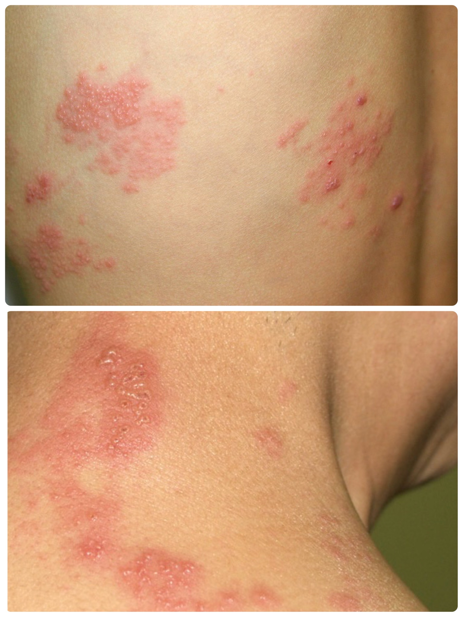 帯状疱疹とヘルペス | 岐阜県下呂市「はり・灸 田中鍼療所」